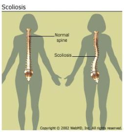 arthritis-scoliosis_scoliosisspine